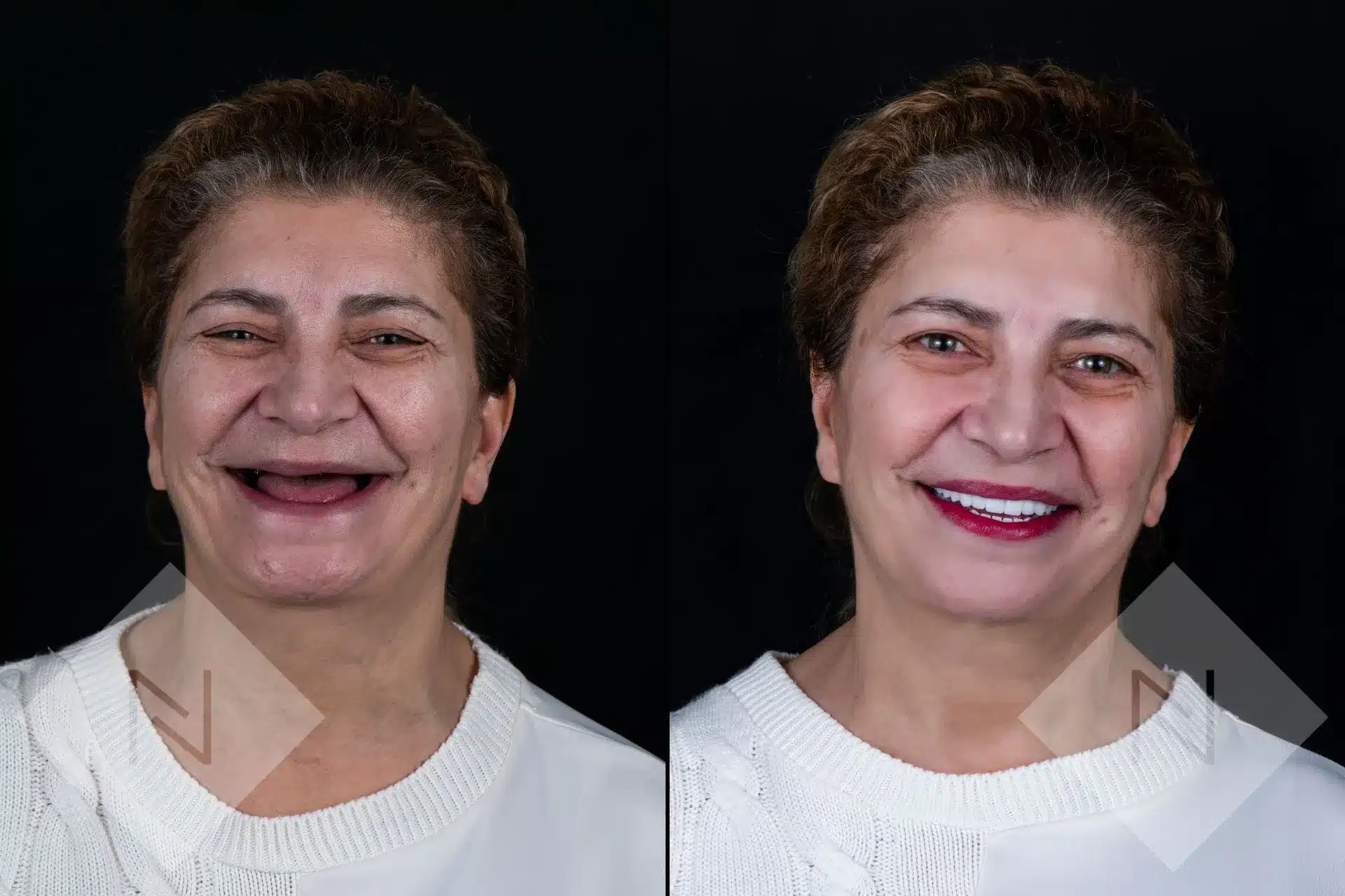 Are Dental Implants Worth the Investment?