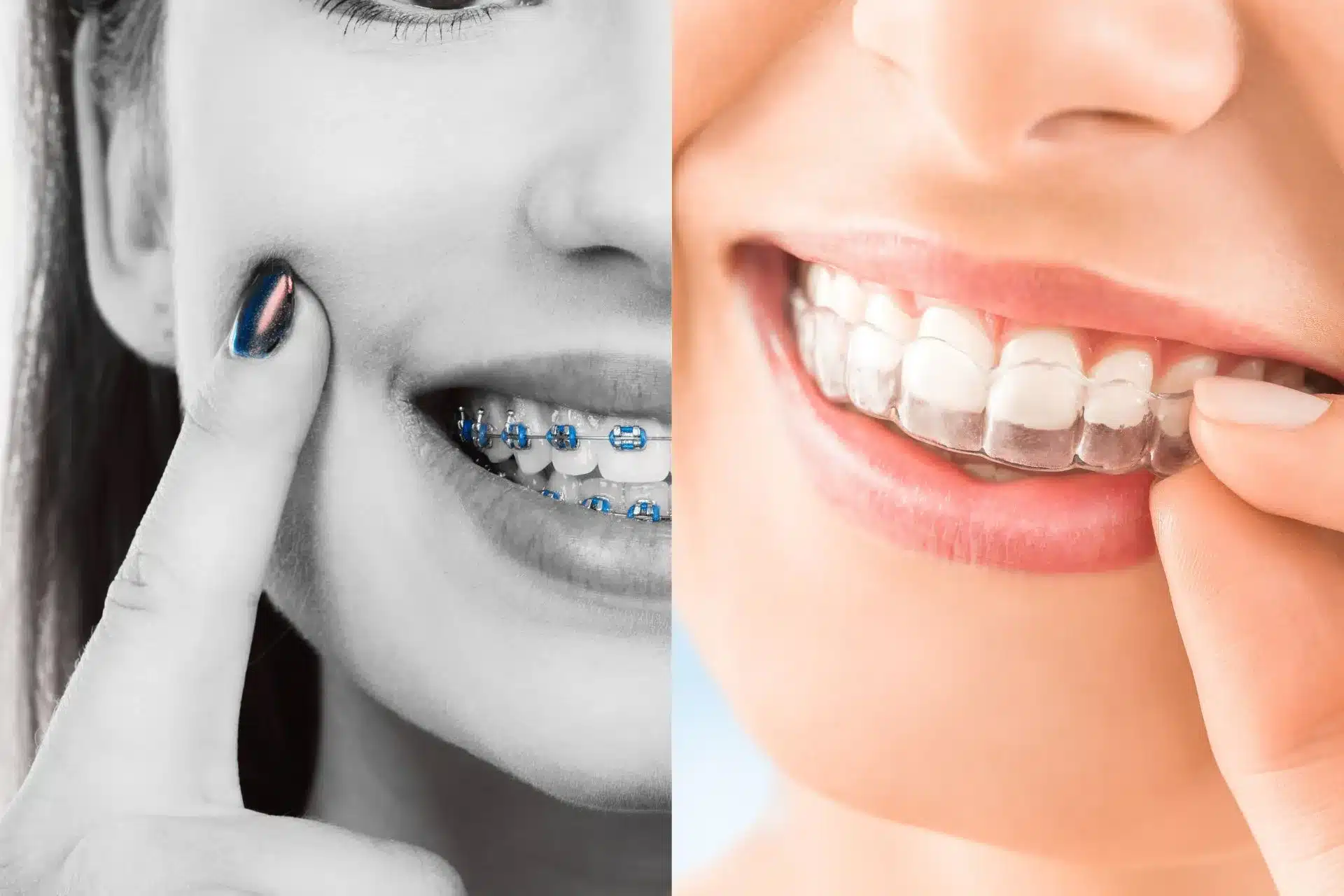 Invisalign vs. Traditional Braces